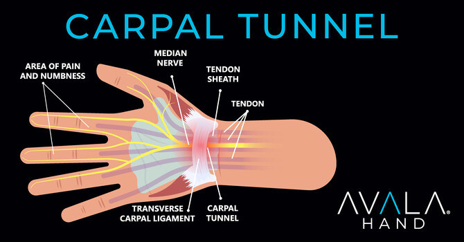 Carpal Tunnel That Does Not Improve With PT or Surgery image