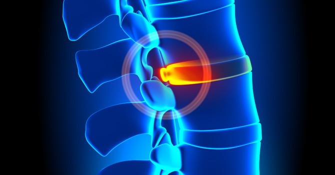 How Adhesion Makes Your Bulging Disc Worse — And What to Do About It